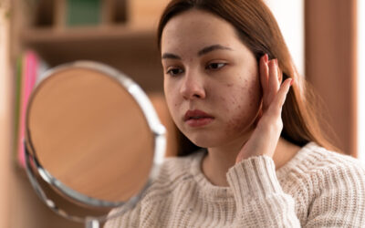 Common Skincare Mistakes Responsible for Acne Breakouts